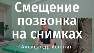 Зміщення хребців на рентгенівських знімках, допуск 3% тобто 1 мм для дорослих | Олександр Афонін