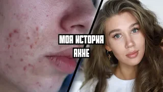 МОЯ ИСТОРИЯ АКНЕ | Приём противозачаточных, беременность, питание