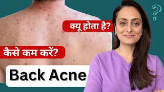 Back acne | क्यूँ होता है | कैसे ठीक करे |  त्वचा के डॉक्टर का सुझाव