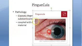 Ophthalmology 095 a PinGueCula What is Eye growth Yellow Degenerative Conjunctiva Reason Etiology
