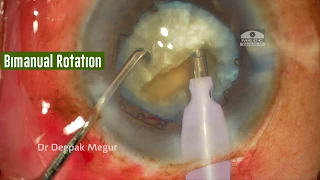 Phacoemulsification in an eye with Pseudoexfoliation, Hard cataract, Loose zonules, Dr Deepak Megur