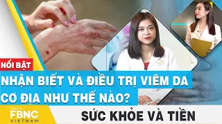 Nhận biết và điều trị viêm da cơ địa như thế nào? | Sức khỏe và tiền | FBNC