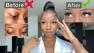 HOW TO GET RID OF DARK CIRCLES PERMANENTLY!! 👀 (Fast and Effective)