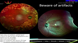 AIOC2020 - IC58 -The Challenges Of Cataract Surgery In Co-Existing Retinal Diseases
