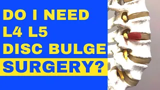 Do I Need L4 L5 Disc Bulge SURGERY And How Do I AVOID Bulging Disc Surgery? | Dr. Walter Salubro