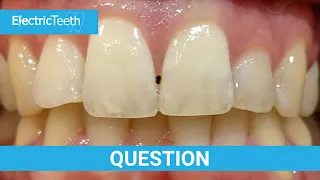 What are the black triangles between teeth?