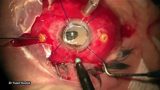 Vitrectomy +Temporary keratoprosthesis+keratoplasty