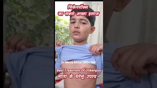 चिकेनपॉक्स का  सबसे  अच्छा  इलाज I  Best Treatment Of chikenpox l माता  के  घरेलू  उपाय