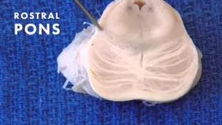 Sensation from the Body: Neuroanatomy Video Lab - Brain Dissections