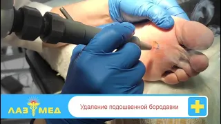 Удаление подошвенной бородавки