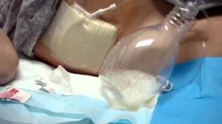 A training video on draining fluid from the abdomen through a Pleurx Catheter.