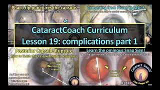 CataractCoach™1777: curriculum lesson 19: complications part 1