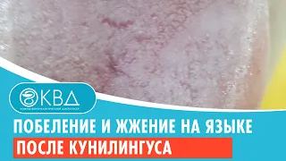 👉 Побеление и жжение на языке после кунилингуса. Клинический случай №664