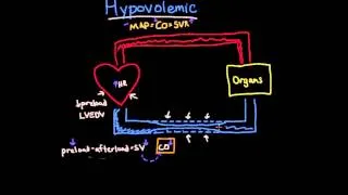 Hypovolemic Shock