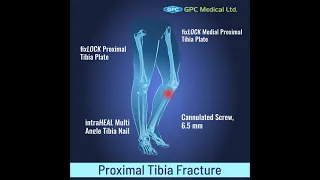 Proximal Tibia Fracture | Orthopedic Trauma Portfolio | GPC Medical Ltd.