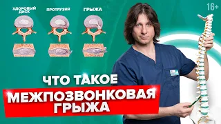 От чего появляется грыжа в позвоночнике? Что делать с межпозвонковой грыжей? #Shorts