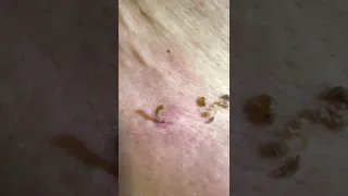 🤣Funniest pore of winer blackhead removal with 3 toddlers commentating 😂🤣