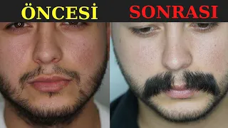 Before and After Mustache Transplant | 1-12 Months | Dr. Hakan Doganay