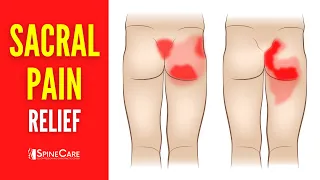 How to Fix Sacral Pain in 30 SECONDS