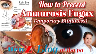 How to prevent Amaurosis Fugax or Temporary Blindness..