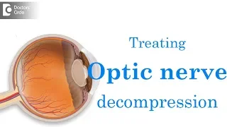 Treatment of orbital and optic nerve decompression - Dr. Harihara Murthy