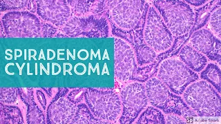 Spiradenoma & Cylindroma...Sweat Gland Tumor Pathology