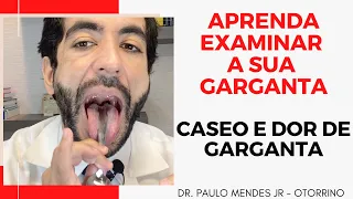 Descubra se tem CASEO NAS AMIGDALAS MASSINHAS FEDORENTAS:  Aprenda a examinar sua garganta