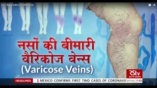 Ayushman Bhava: वैरिकोज वेन्स - नसों की बीमारी | Symptoms & Prevention of Varicose Veins