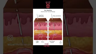 Dry needling therapy for heel pain🦶#heelpaintreatment #shorts