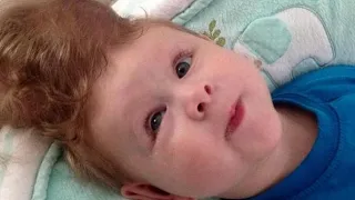 Baby Born with Brain Outside of Skull Gets Life-Changing Surger