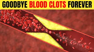 Say Goodbye to Blood Clots Forever : Top 8 Foods That Naturally Melt Away Blood Clots!