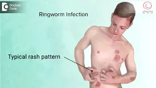 How to manage Chronic Ringworm infection