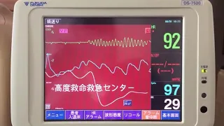 【症例A】生体情報モニタ ベッドサイドモニタ