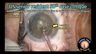 CataractCoach 1296: US senior resident case 50 critique