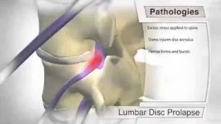 Lumbar Disc Prolapse Pathology Procedure Animation