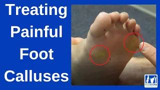 How to Treat Painful Foot Calluses