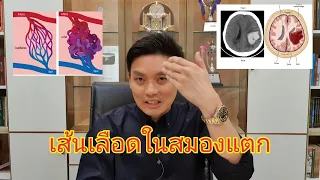 Youtuber สายกิน เส้นเลือดในสมองแตกตาย! สาเหตุจากอะไร?