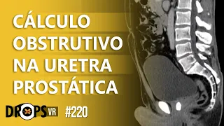 CÁLCULO OBSTRUTIVO NA URETRA PROSTÁTICA