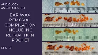 EAR WAX REMOVAL INCLUDING RETRACTION POCKET - EP151