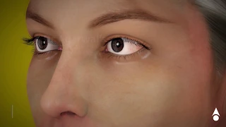 Cataract animation for Patient Education