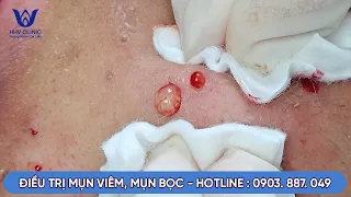 ĐIỀU TRỊ MỤN VIÊM, MỤN BỌC TUỔI DẬY THÌ, CHO EM TRAI SINH VIÊN TẠI PHÒNG KHÁM DA LIỄU HHV CLINIC. P2