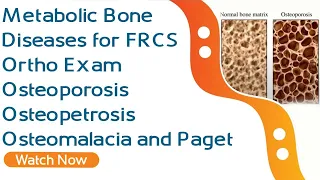 Metabolic Bone Diseases for FRCS Ortho Exam | Osteoporosis , Osteopetrosis , Osteomalacia and Paget