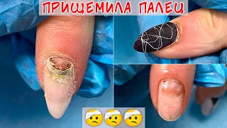 Прищемила палец на руке / Позеленел ноготь под гелем😨