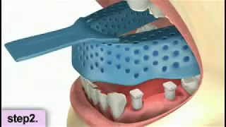 Implantologia 2 impianti e ponte di 3 elementi