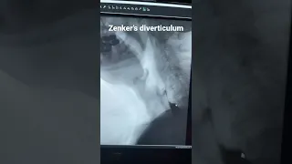 Mechanism of Zenker’s diverticulum seen on X ray fluoroscopy