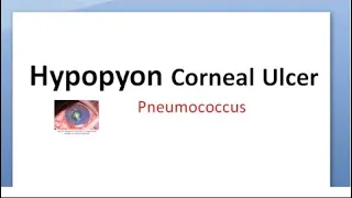 Ophthalmology 112 b Hypopyon Corneal Ulcer Strepcococcus pneumoniae Pneumococcus ulcus serpens