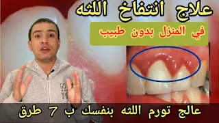 علاج انتفاخ اللثه |7 طرق فعاله لعلاج تورم اللثه في المنزل بدون طبيب