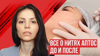 Подтяжка лица нитями Аптос. До и после, техника выполнения.