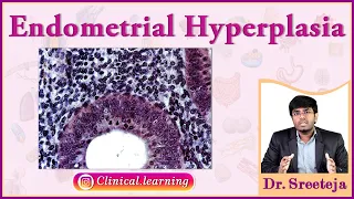 48. Endometrial Hyperplasia