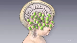 Managing Meningitis - Mayo Clinic